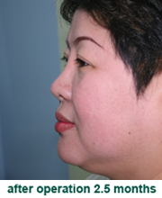 plastic_surgery_augmentation_rhinoplasty